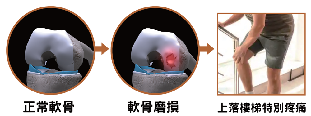 軟骨磨損